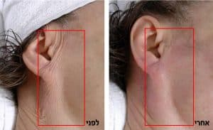 הצערת עור הפנים הצערת עור הפנים