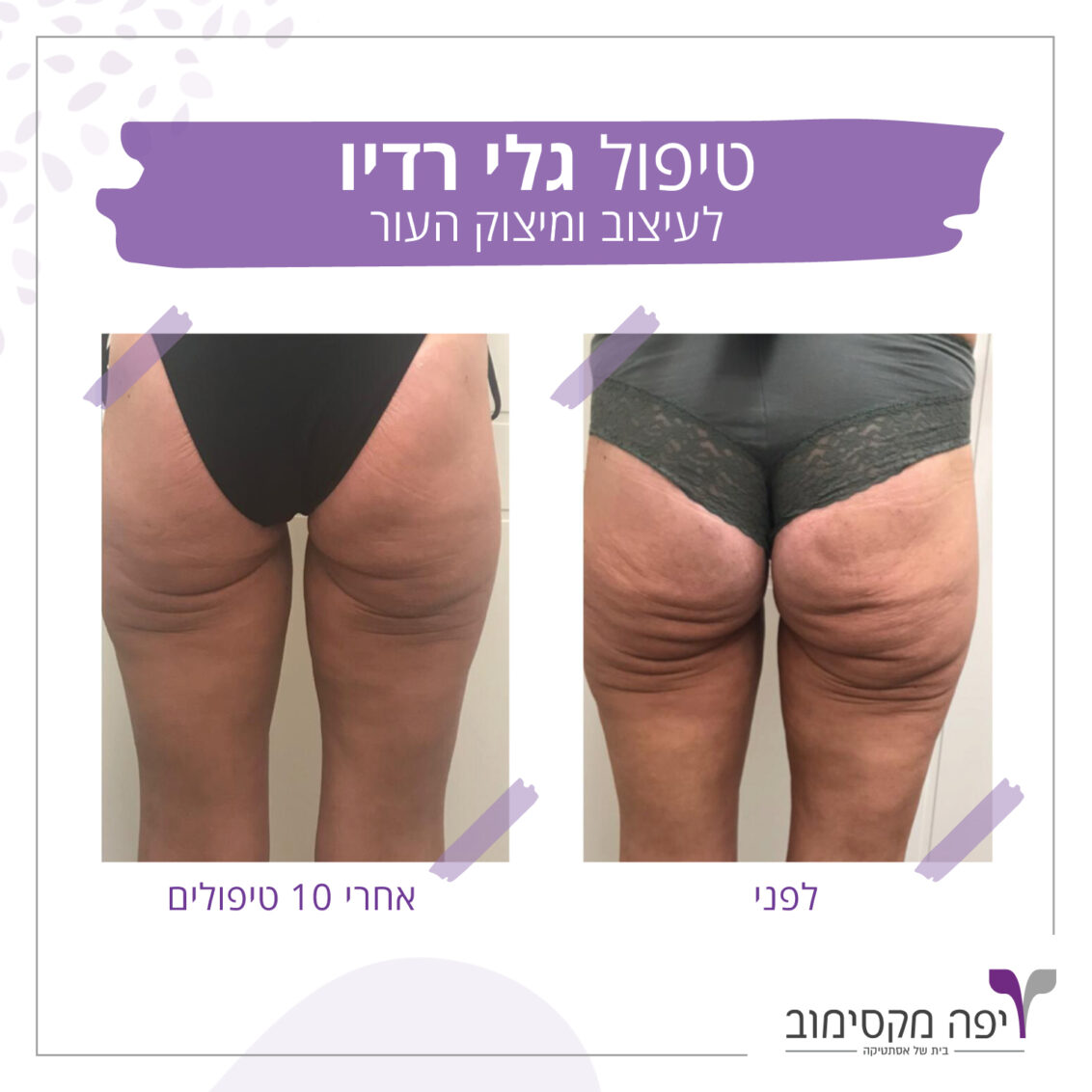המסת שומן וצלוליט